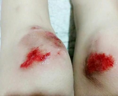 梦见摔跤腿破